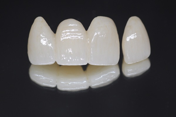 Full Mouth Reconstruction: Replacing Teeth With Dental Bridges